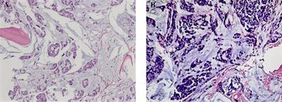 Long-term stable disease with mFOLFOX6 chemotherapy plus cetuximab for bone marrow metastasis from rectal cancer: A case report